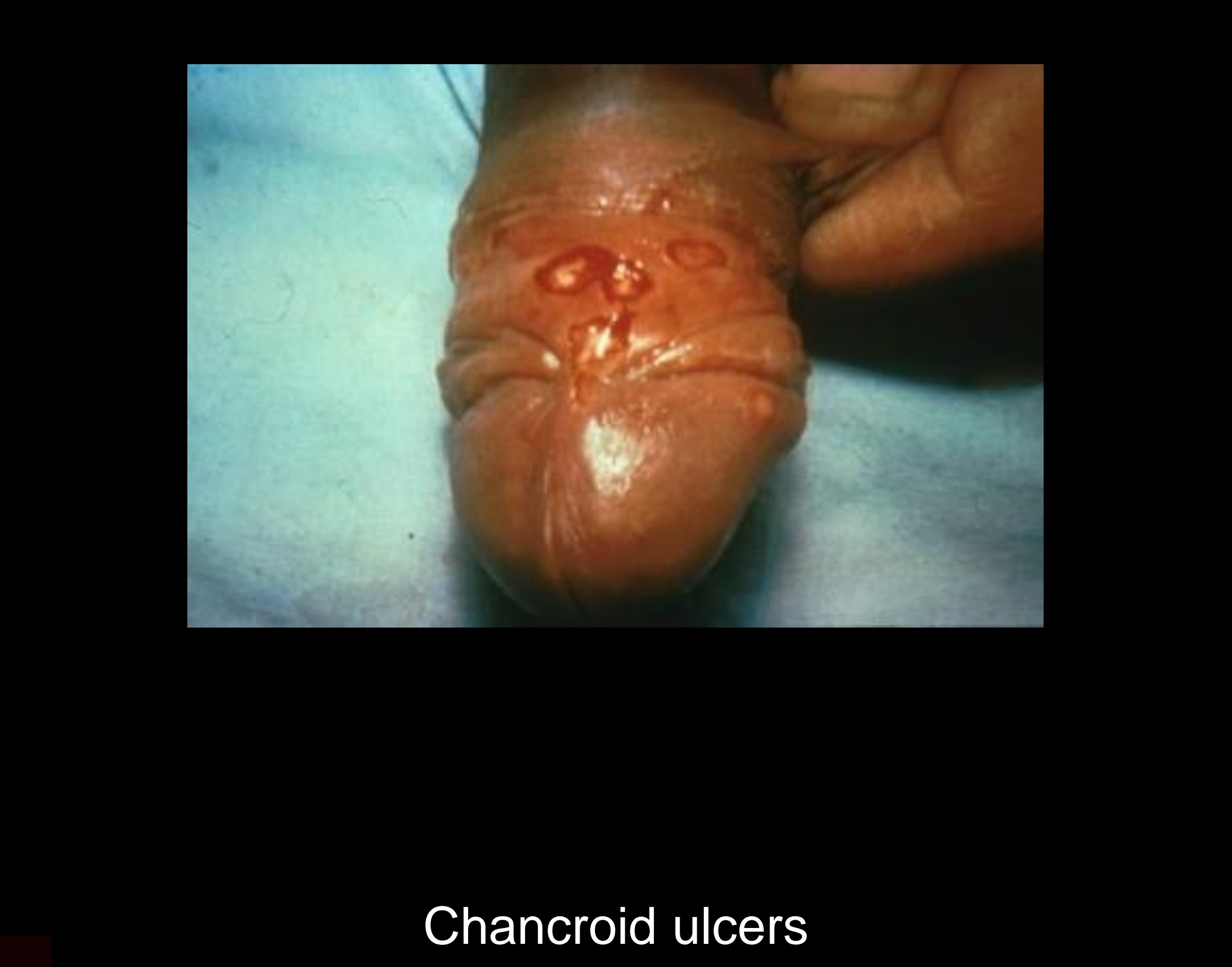 Chancroid painful genital ulcer on male foreskin showing characteristic ragged undermined borders and necrotic exudate - clinical presentation at STD Nepal